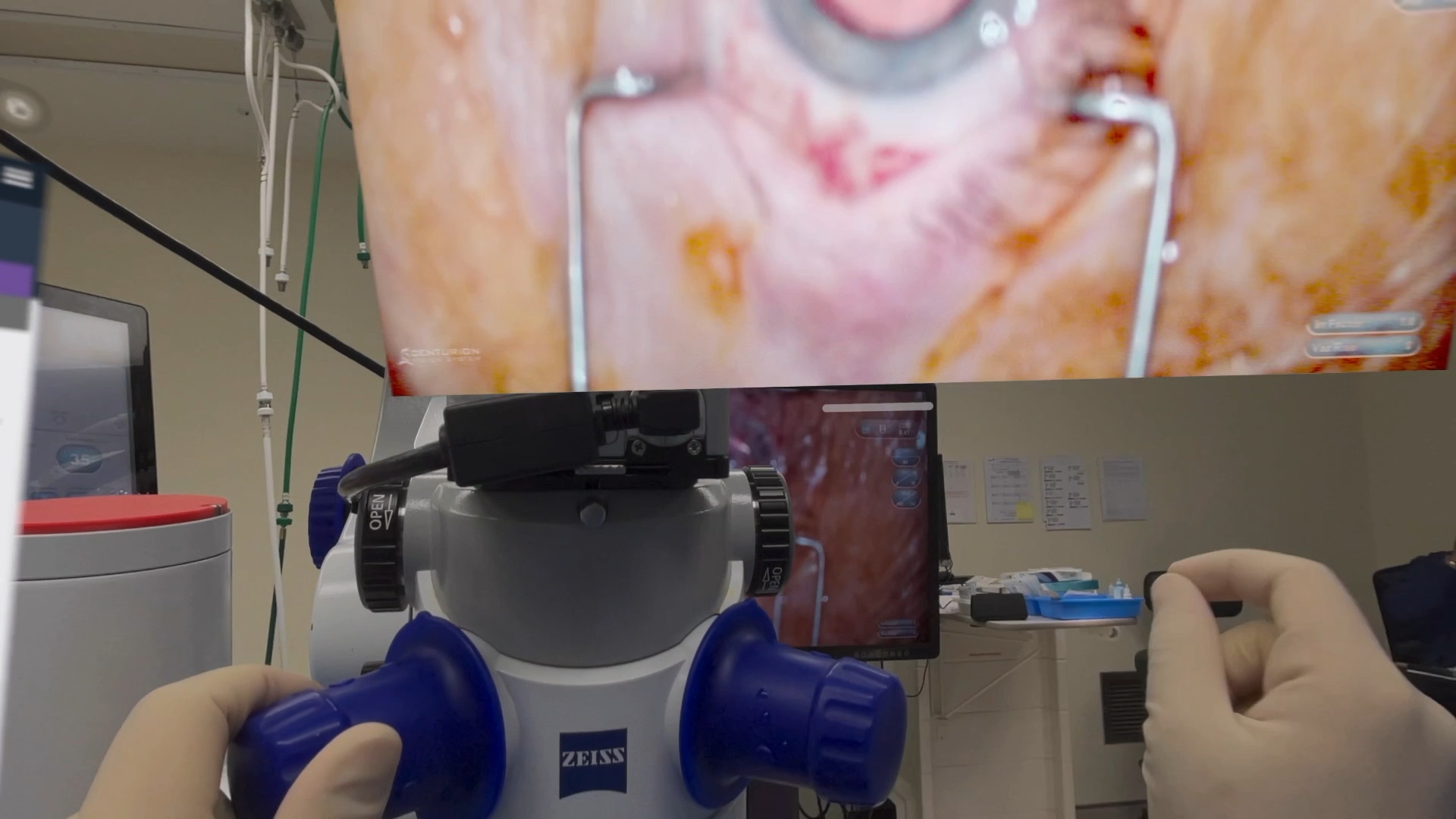Latex-gloved hands clear of the surgical microscope controls while spatial video remains visible above.